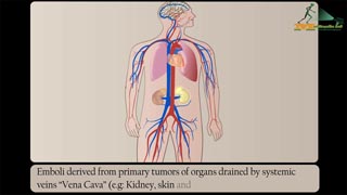 Cancer Spread